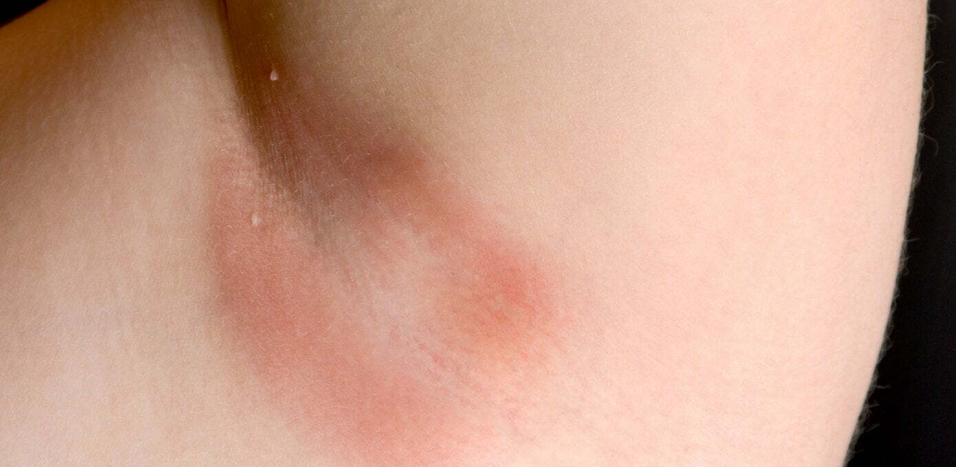 Causes and treatment of acne inside the armpit