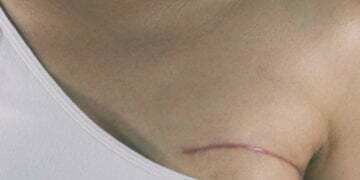 Tells You About Having Breast Cancer