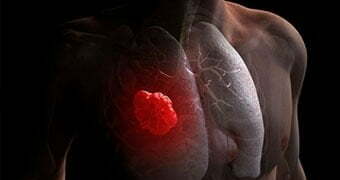 Too many antioxidants can also reason lung most cancers spread