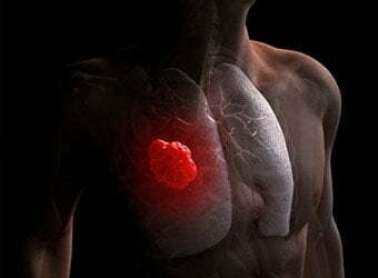 Too many antioxidants can also reason lung most cancers spread