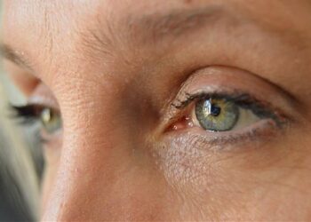 Cholesterol Eyes That Are Truly Dangerous