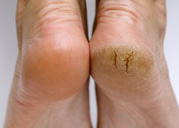 This DIY home cure for cracked heels works like an appeal!
