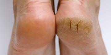 This DIY home cure for cracked heels works like an appeal!