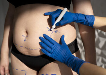 Why Consider Liposuction?