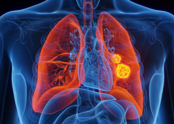 ‘I became stunned after they stated it turned into lung cancer’