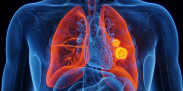 ‘I became stunned after they stated it turned into lung cancer’