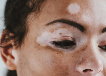 World Vitiligo Day