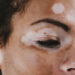 World Vitiligo Day