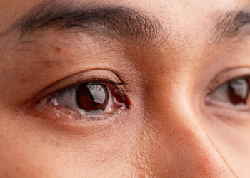 Tear Duct Blockage Home Remedies – How To Get Rid of Tear Duct Blockage
