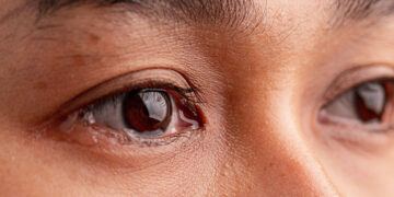 Tear Duct Blockage Home Remedies – How To Get Rid of Tear Duct Blockage