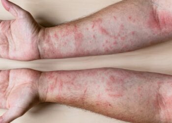 Millions susceptible to deadly allergies
