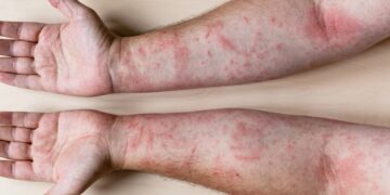 Millions susceptible to deadly allergies