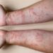Millions susceptible to deadly allergies